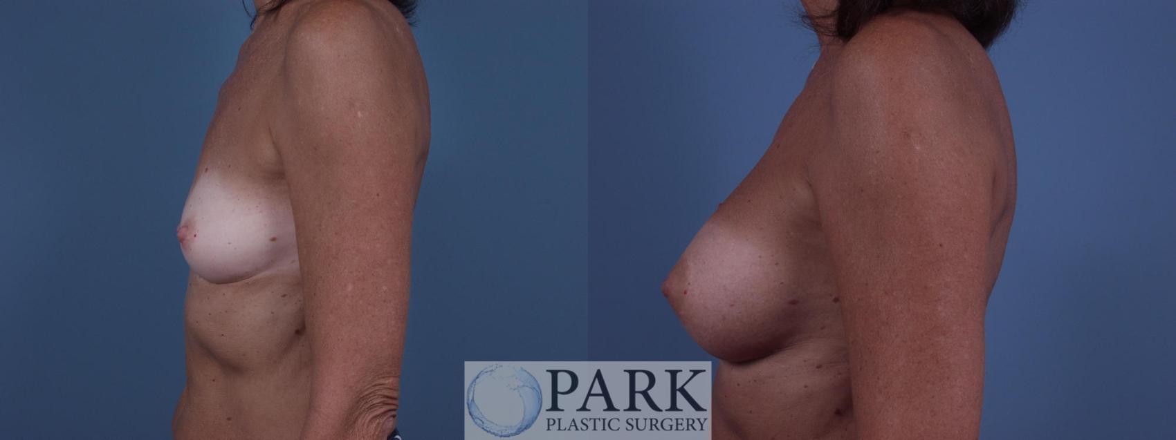 Before & After Breast Augmentation Case 45 Left Side View in Rocky Mount & Greenville, NC