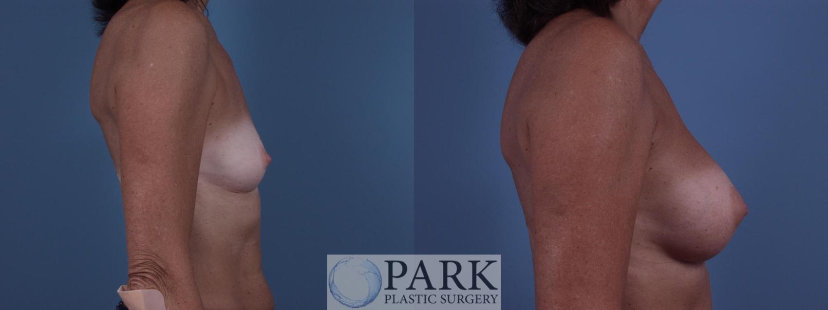 Before & After Breast Augmentation Case 45 Right Side View in Rocky Mount & Greenville, NC