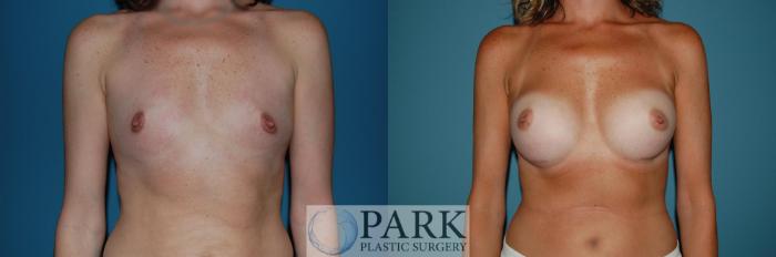 Before & After Breast Augmentation Case 46 Front View in Rocky Mount, NC