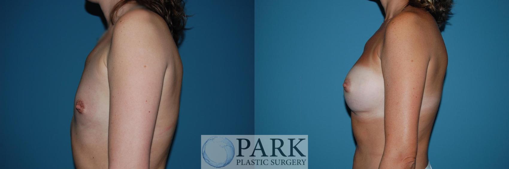 Before & After Breast Augmentation Case 46 Left Side View in Rocky Mount & Greenville, NC