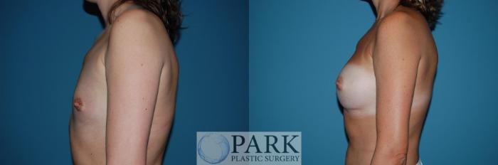 Before & After Breast Augmentation Case 46 Left Side View in Rocky Mount & Greenville, NC