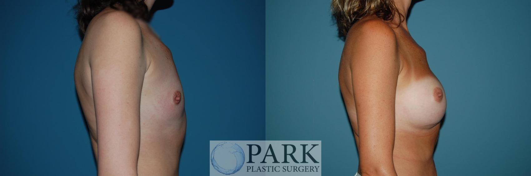 Before & After Breast Augmentation Case 46 Right Side View in Rocky Mount & Greenville, NC