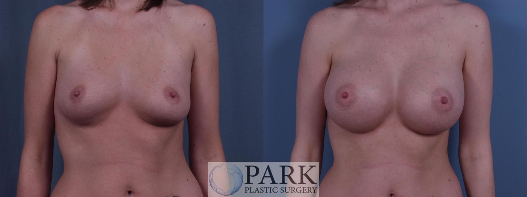 Before & After Breast Augmentation Case 47 Front View in Rocky Mount, NC