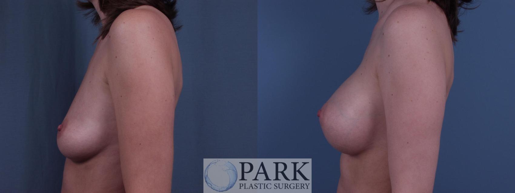 Before & After Breast Augmentation Case 47 Left Side View in Rocky Mount & Greenville, NC