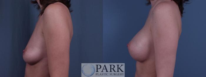 Before & After Breast Augmentation Case 47 Left Side View in Rocky Mount, NC