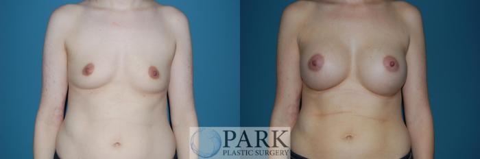 Before & After Breast Augmentation Case 48 Front View in Rocky Mount, NC