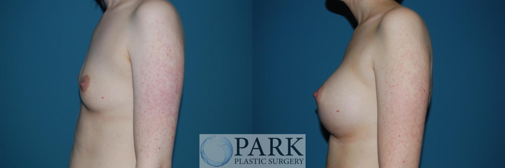 Before & After Breast Augmentation Case 48 Left Side View in Rocky Mount & Greenville, NC
