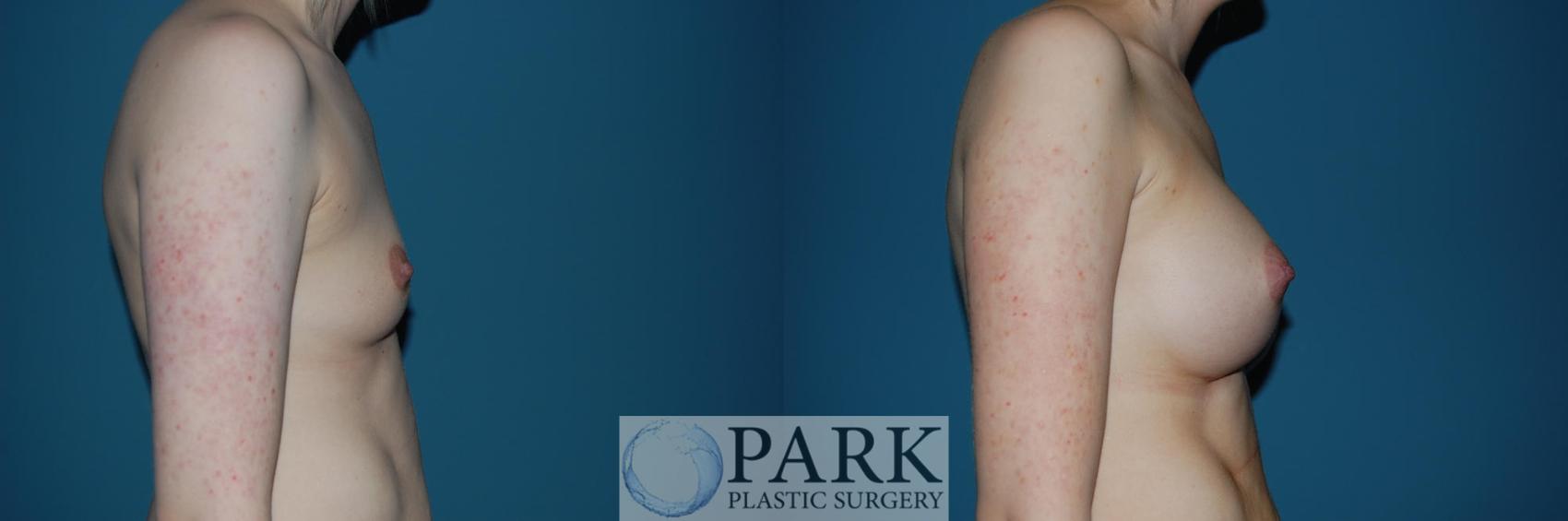 Before & After Breast Augmentation Case 48 Right Side View in Rocky Mount & Greenville, NC
