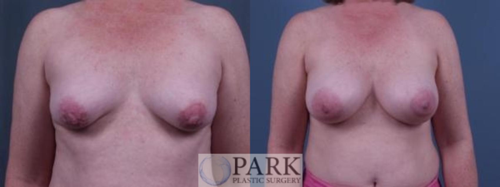 Before & After Breast Augmentation Case 49 Front View in Rocky Mount, NC