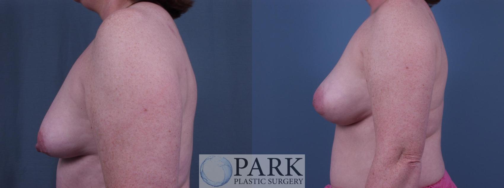 Before & After Breast Augmentation Case 49 Left Side View in Rocky Mount & Greenville, NC
