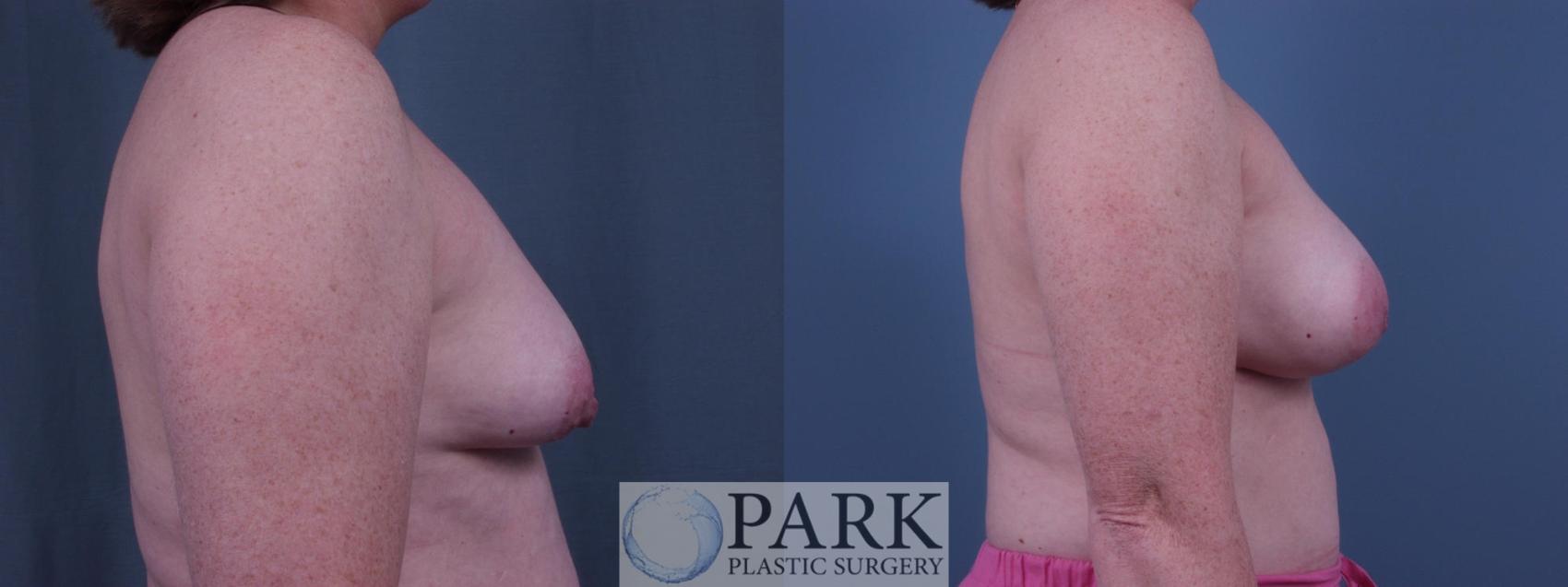 Before & After Breast Augmentation Case 49 Right Side View in Rocky Mount & Greenville, NC