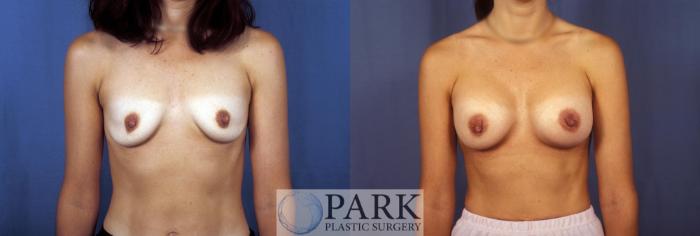 Before & After Breast Augmentation Case 50 Front View in Rocky Mount, NC