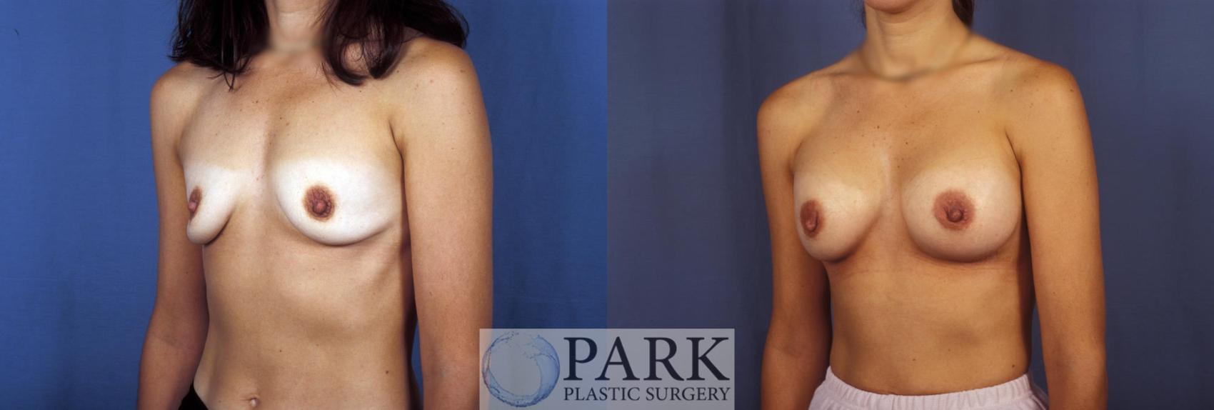 Before & After Breast Augmentation Case 50 Left Oblique View in Rocky Mount & Greenville, NC