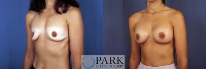 Before & After Breast Augmentation Case 50 Left Oblique View in Rocky Mount, NC