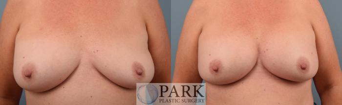 Breast Augmentation Implant Replacement
