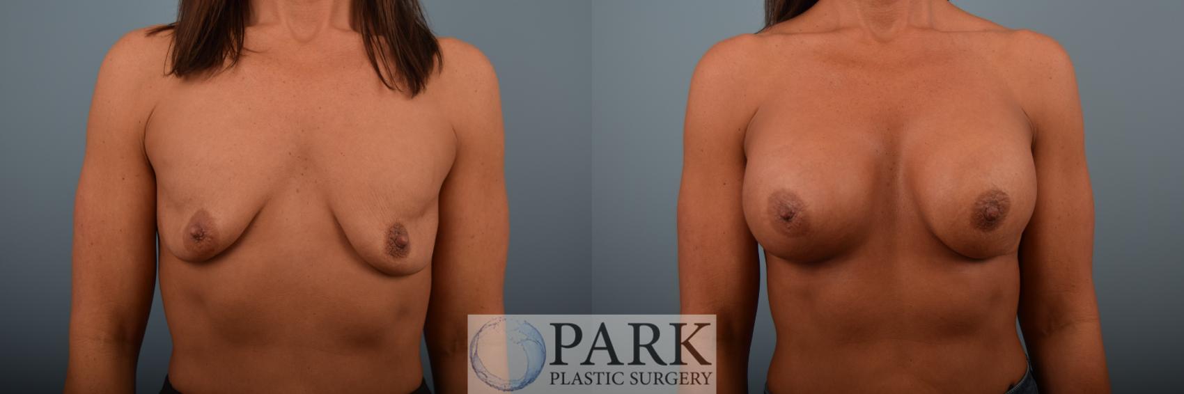 Breast Augmentation with Silicone Gel Implants