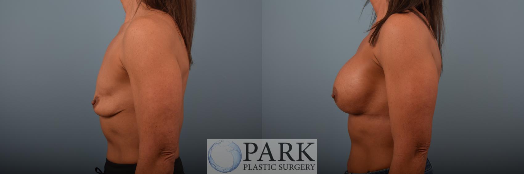 Before & After Breast Augmentation Case 87 Left Side View in Rocky Mount & Greenville, NC