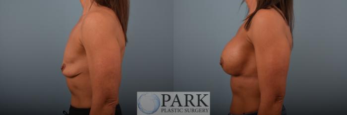 Before & After Breast Augmentation Case 87 Left Side View in Rocky Mount & Greenville, NC