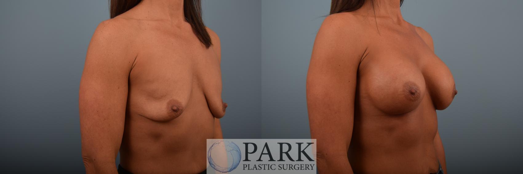 Before & After Breast Augmentation Case 87 Right Oblique View in Rocky Mount & Greenville, NC
