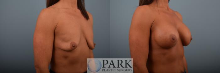 Before & After Breast Augmentation Case 87 Right Oblique View in Rocky Mount & Greenville, NC