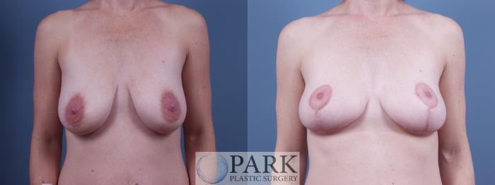 Before & After Breast Lift Case 26 Front View in Rocky Mount, NC