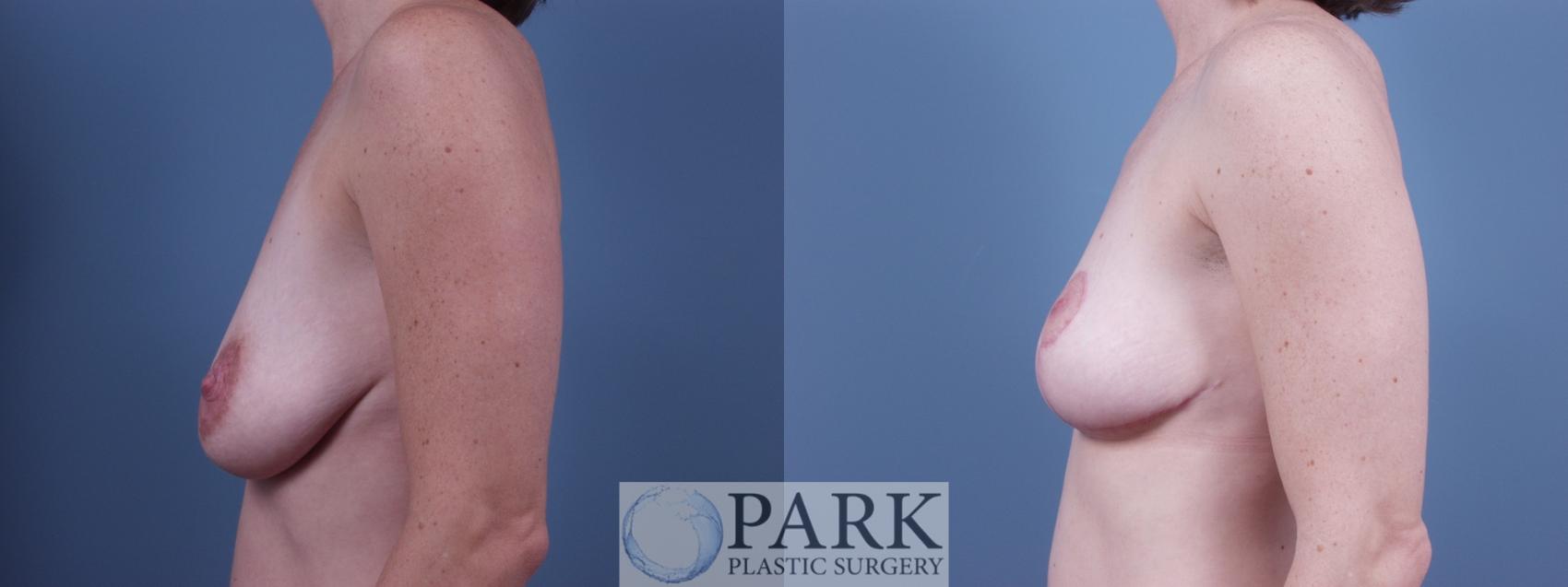 Before & After Breast Lift Case 26 Left Side View in Rocky Mount & Greenville, NC