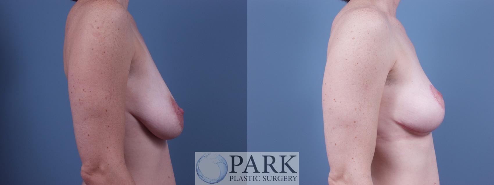 Before & After Breast Lift Case 26 Right Side View in Rocky Mount & Greenville, NC