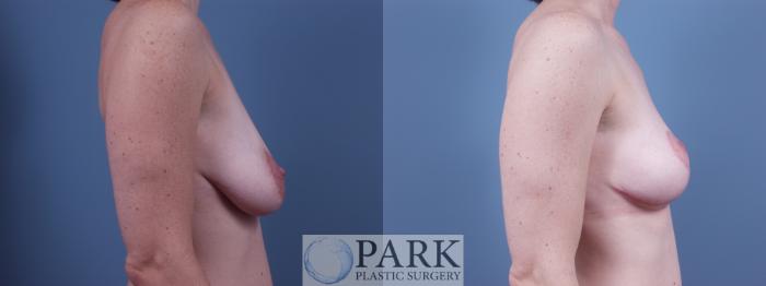 Before & After Breast Lift Case 26 Right Side View in Rocky Mount, NC