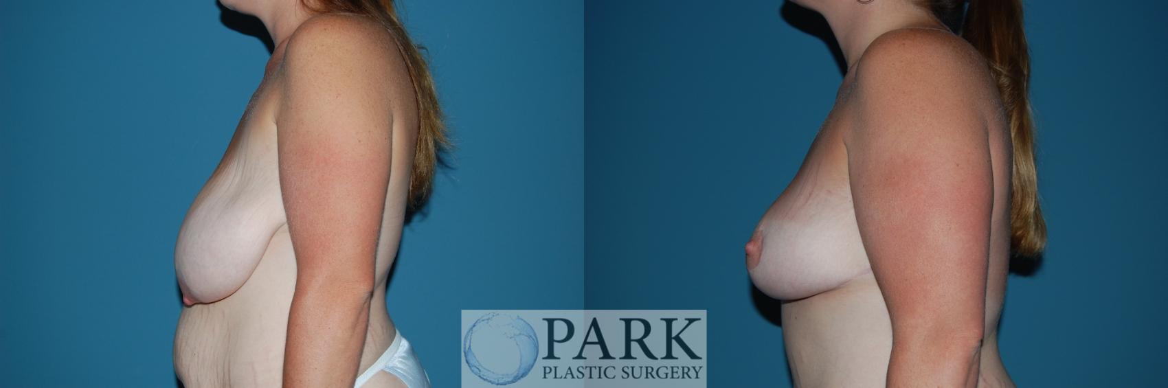 Before & After Breast Lift Case 27 Left Side View in Rocky Mount & Greenville, NC