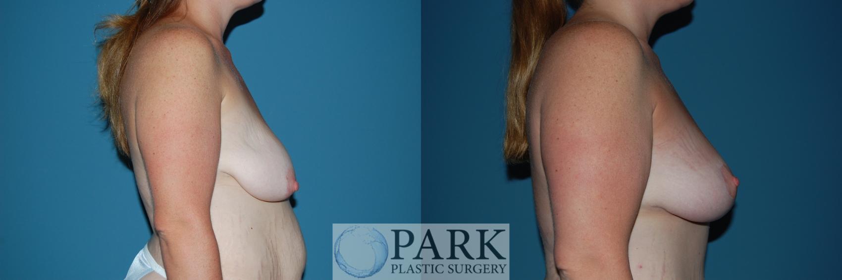 Before & After Breast Lift Case 27 Right Side View in Rocky Mount & Greenville, NC