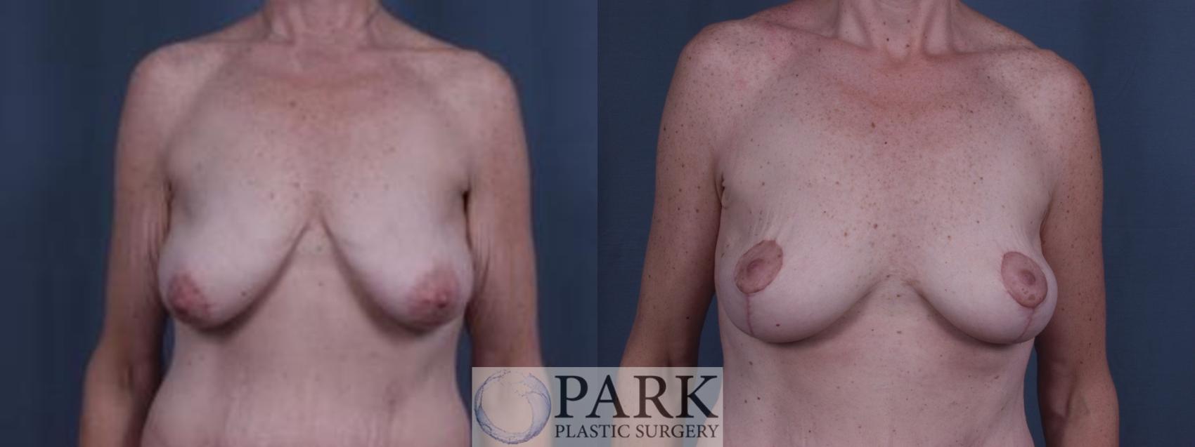Before & After Breast Lift Case 28 Front View in Rocky Mount, NC