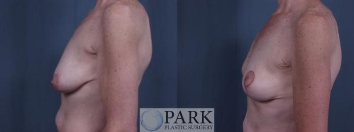 Before & After Breast Lift Case 28 Left Side View in Rocky Mount, NC