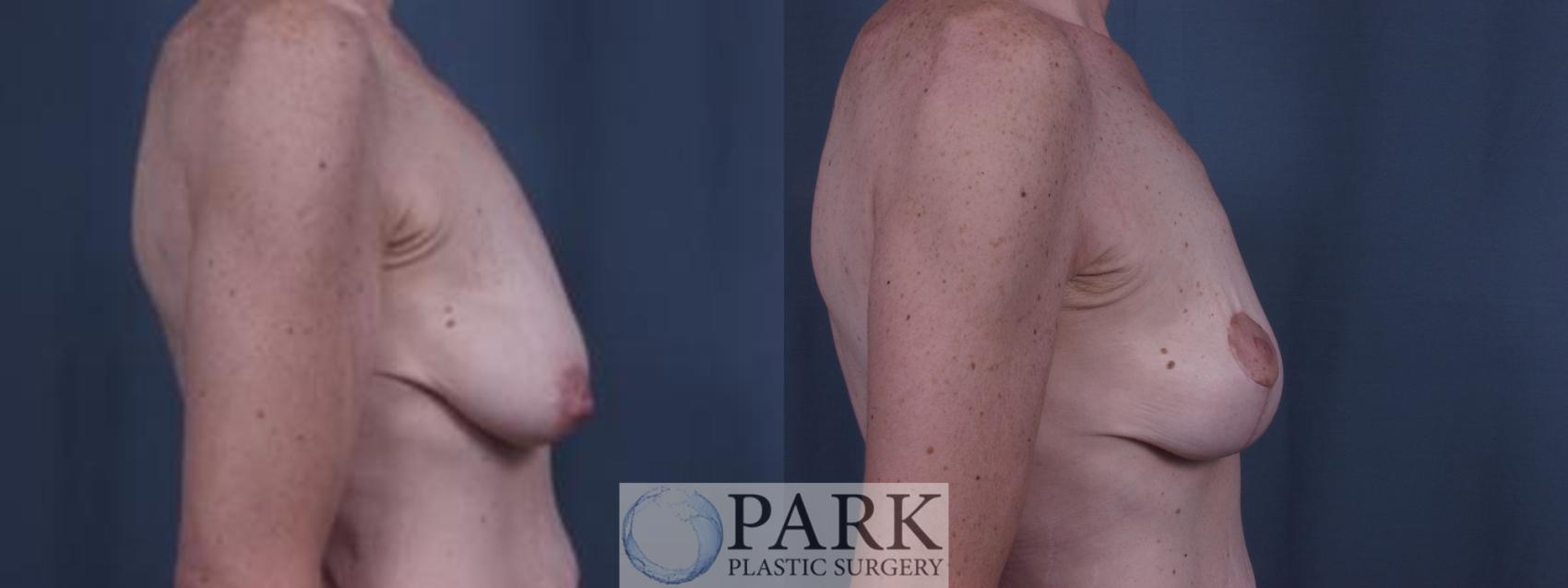 Before & After Breast Lift Case 28 Right Side View in Rocky Mount & Greenville, NC