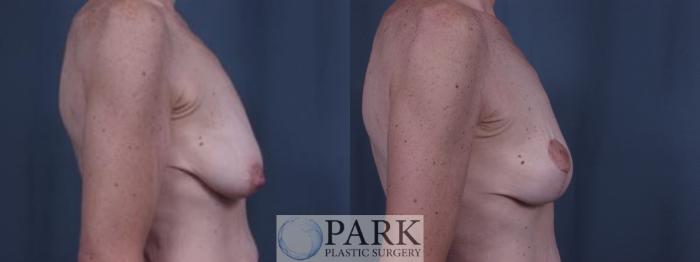 Before & After Breast Lift Case 28 Right Side View in Rocky Mount, NC