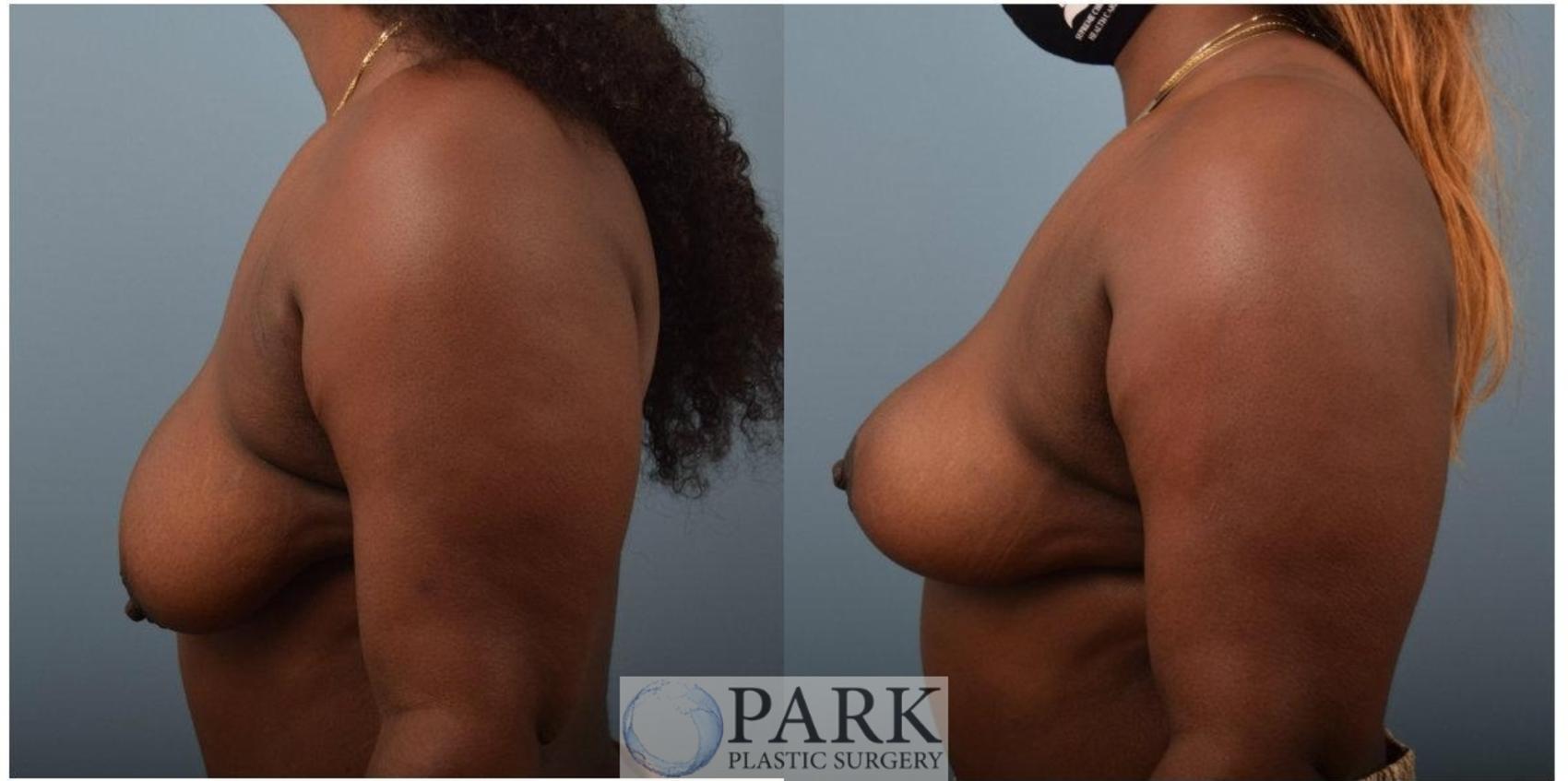 Before & After Breast Lift Case 55 Left Side View in Rocky Mount & Greenville, NC