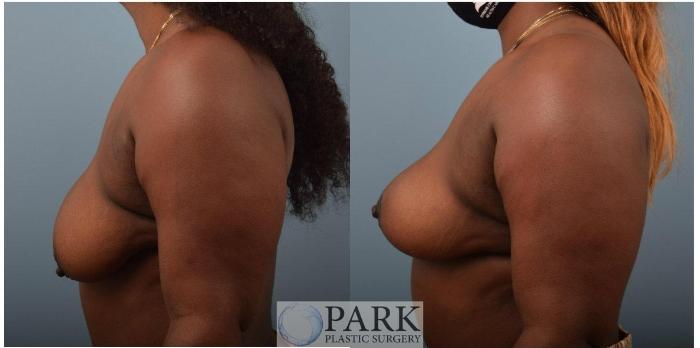Before & After Breast Lift Case 55 Left Side View in Rocky Mount, NC