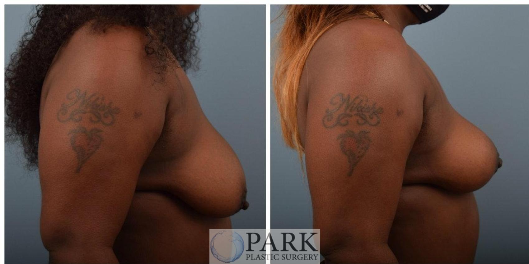 Before & After Breast Lift Case 55 Right Side View in Rocky Mount & Greenville, NC