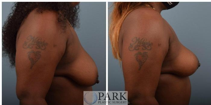 Before & After Breast Lift Case 55 Right Side View in Rocky Mount, NC