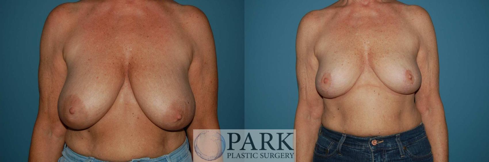 Before & After Breast Reduction Case 29 Front View in Rocky Mount, NC