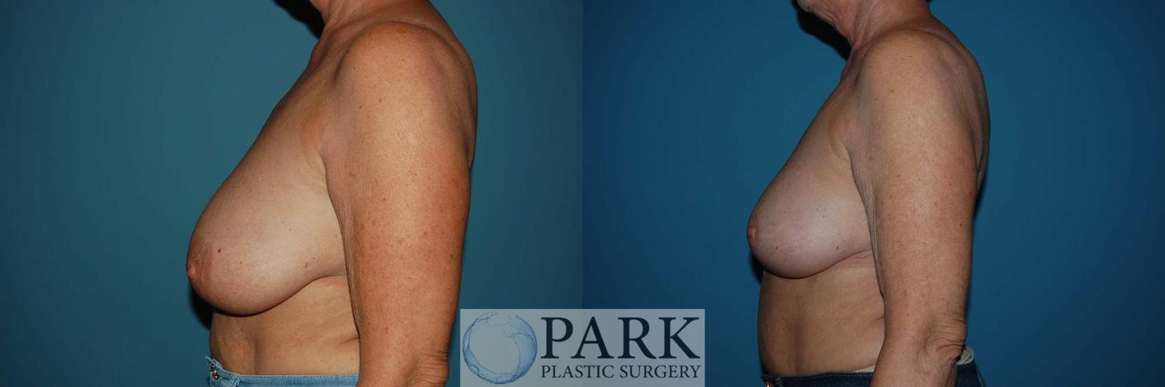 Before & After Breast Reduction Case 29 Left Side View in Rocky Mount & Greenville, NC
