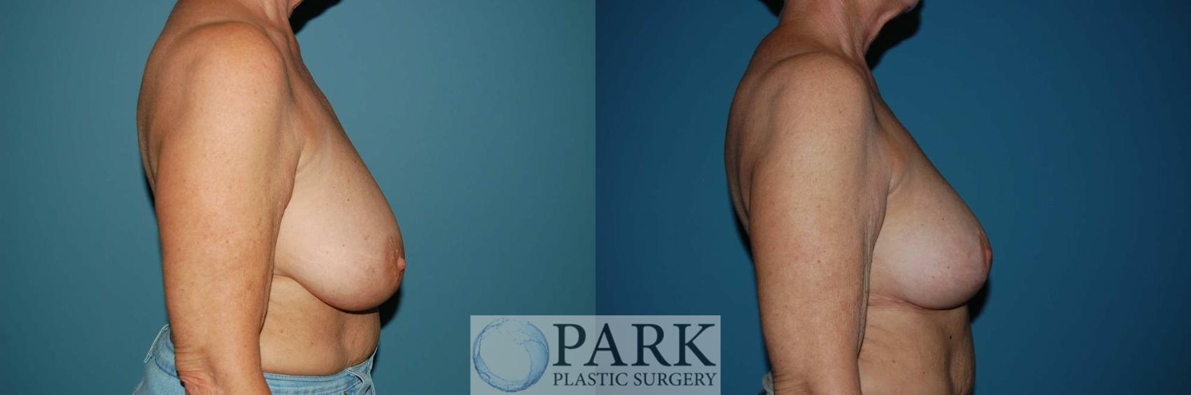 Before & After Breast Reduction Case 29 Right Side View in Rocky Mount & Greenville, NC