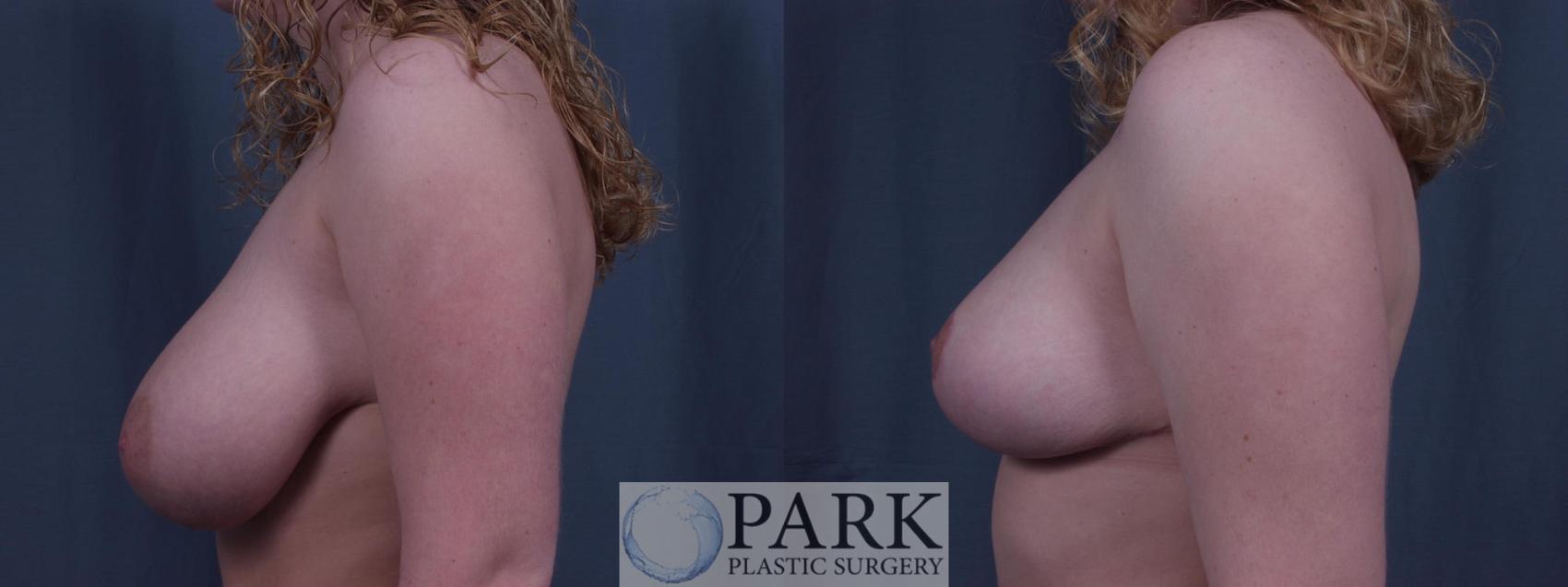 Before & After Breast Reduction Case 30 Left Side View in Rocky Mount & Greenville, NC