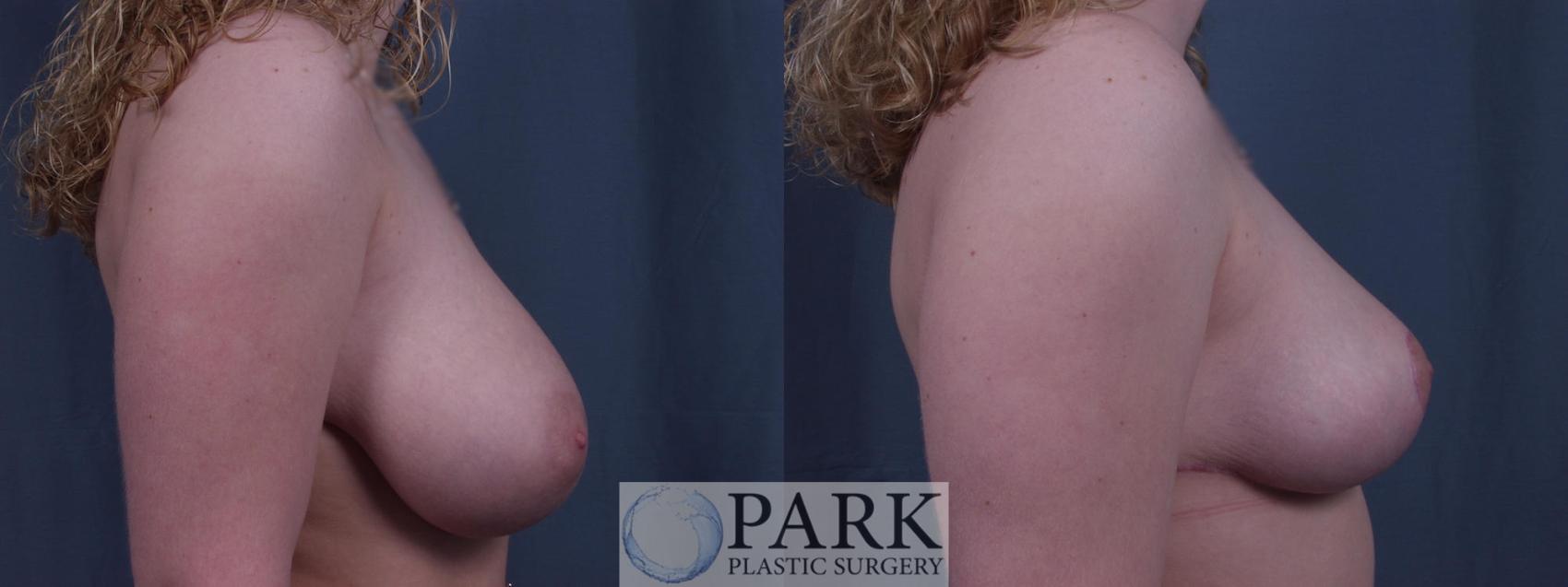 Before & After Breast Reduction Case 30 Right Side View in Rocky Mount & Greenville, NC