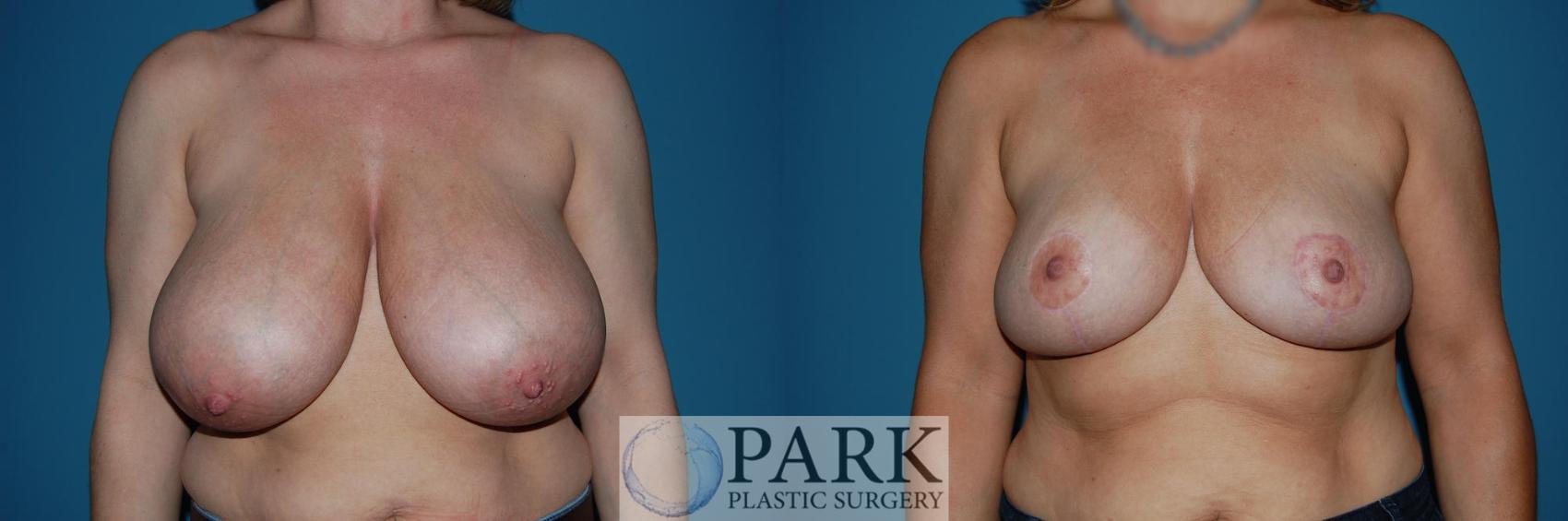 Before & After Breast Reduction Case 31 Front View in Rocky Mount, NC