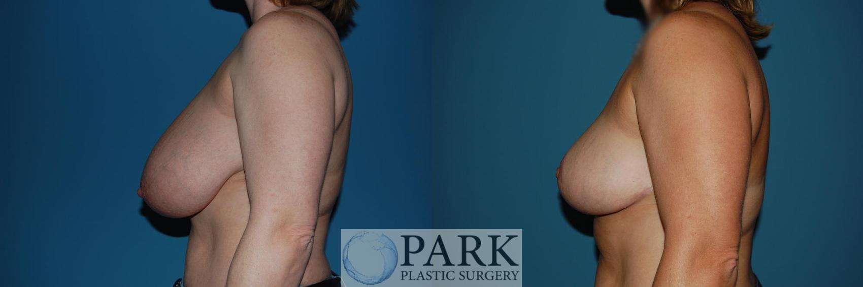 Before & After Breast Reduction Case 31 Left Side View in Rocky Mount & Greenville, NC