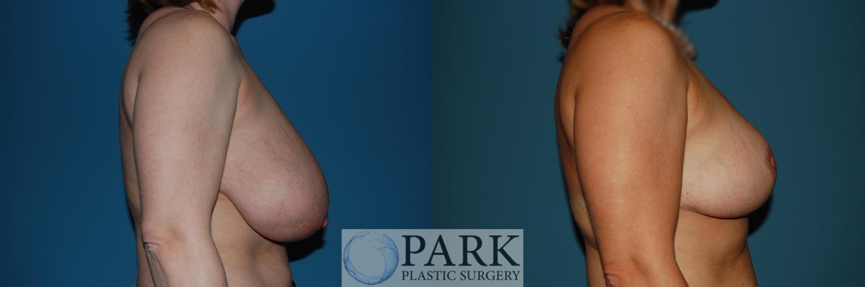 Before & After Breast Reduction Case 31 Right Side View in Rocky Mount & Greenville, NC