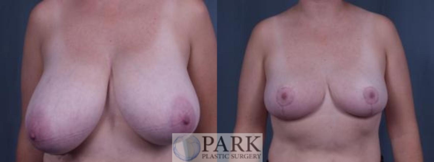 Before & After Breast Reduction Case 32 Front View in Rocky Mount, NC