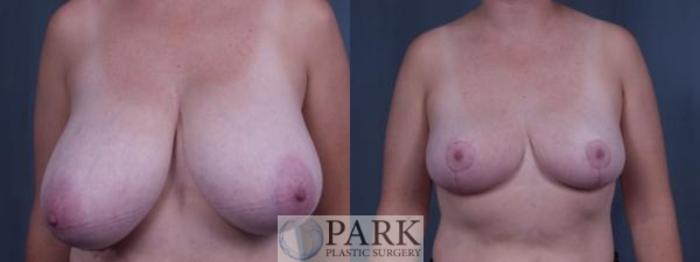 Before & After Breast Reduction Case 32 Front View in Rocky Mount, NC