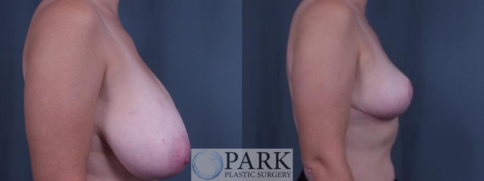 Before & After Breast Reduction Case 32 Right Side View in Rocky Mount & Greenville, NC