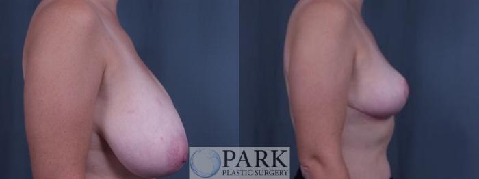 Before & After Breast Reduction Case 32 Right Side View in Rocky Mount, NC